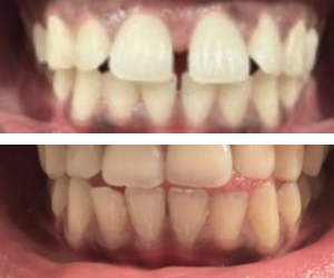 Mild Overbite