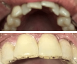 Gap Closure